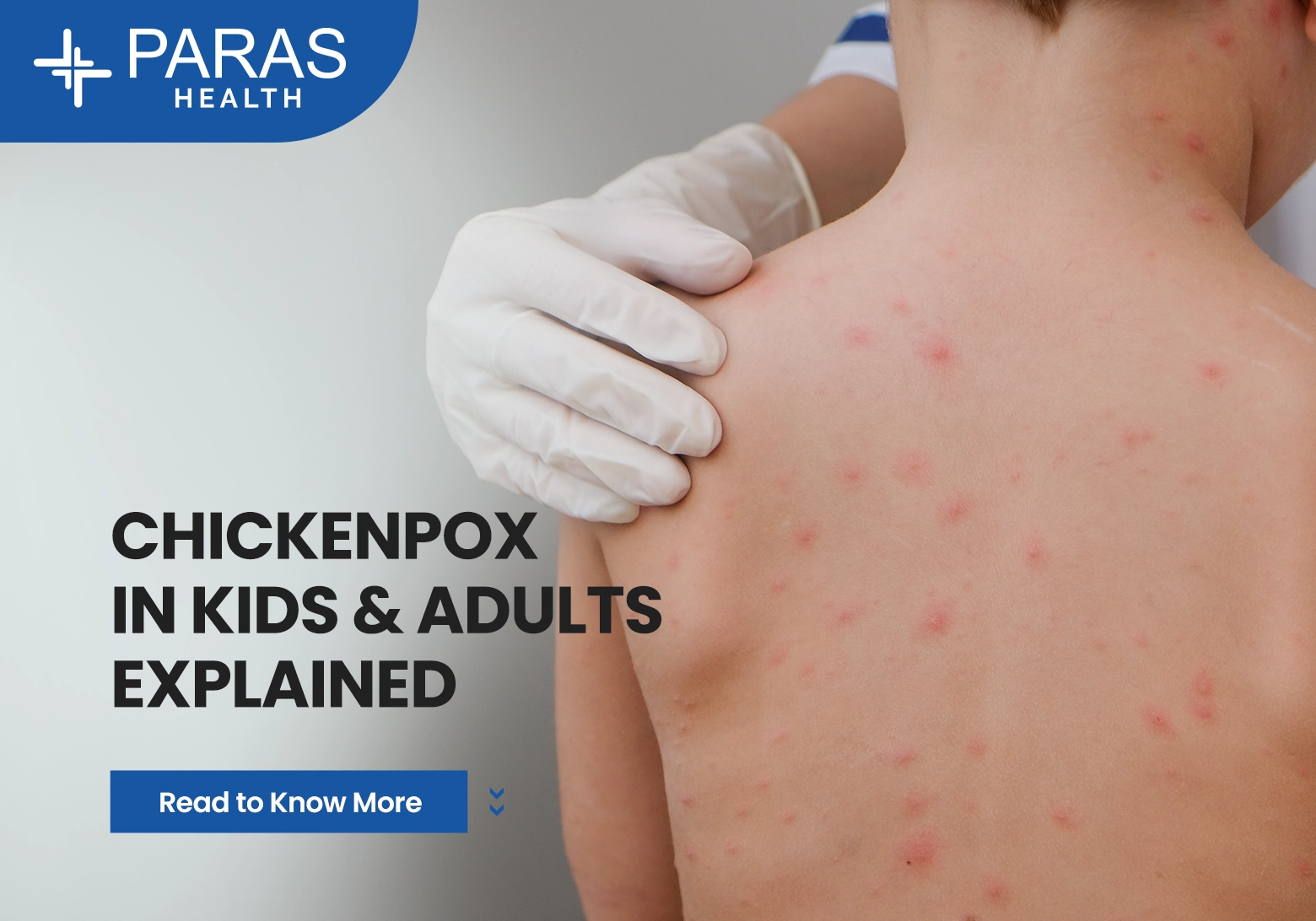 Chickenpox in Kids & Adults Explained: Causes, Symptoms, Treatment & Prevention